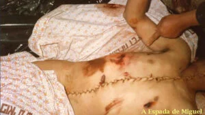 Israel líder mundial no Tráfico de órgãos e seres humanos com apoio dos EUA e Turquia 3 corpo-palestino-violado-retirada-orgaos